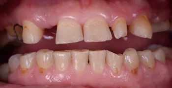 Before dental treatment