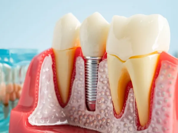 Cost of dental implants