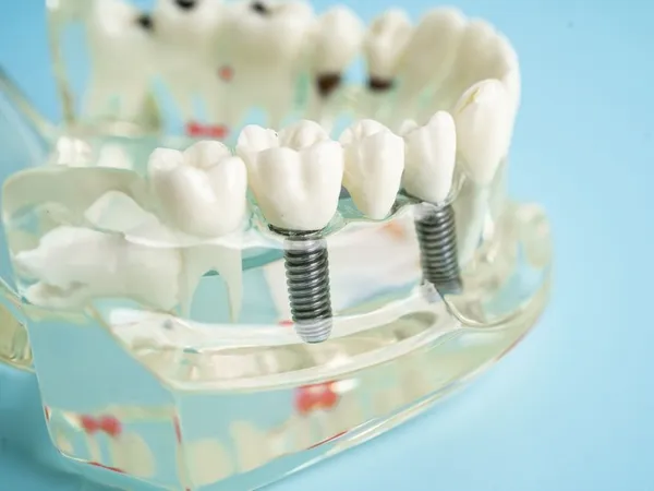 Dental implant investment