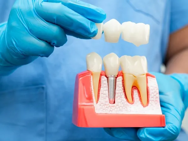 Dental implant healing process
