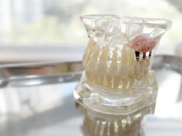 Sinus lift procedure